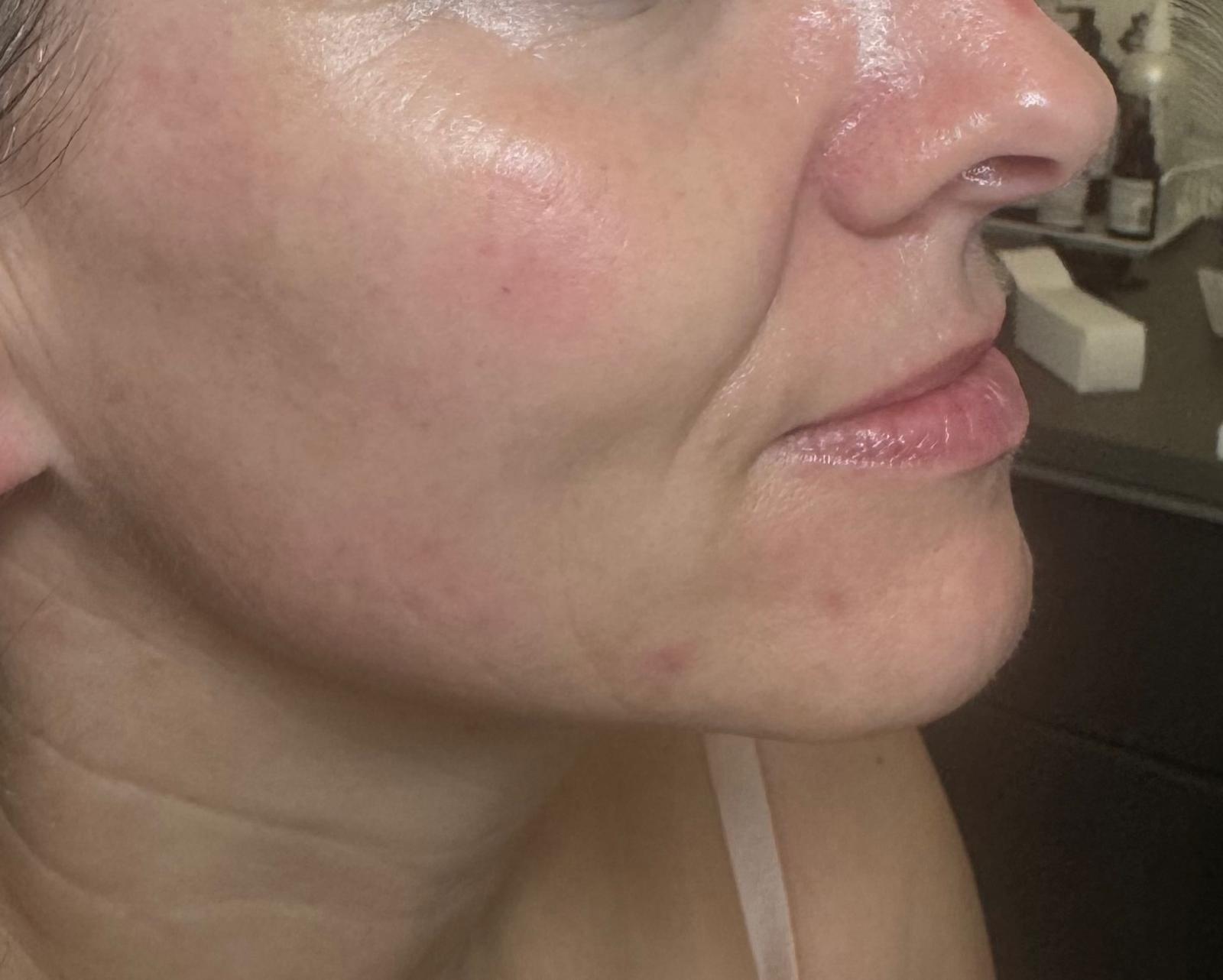 Hautbild einer Kundin im Vergleich vor und nach dem Hollywood-Peeling